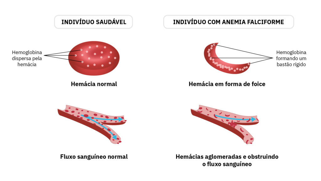 Ilustração comparando as hemácias de uma pessoa saudável e as hemácias de um pessoa com anemia falciforme (na parte superior). Na parte inferior, a comparação do fluxo sanguíneo em uma pessoa saudável e em uma pessoa com anemia falciforme.
