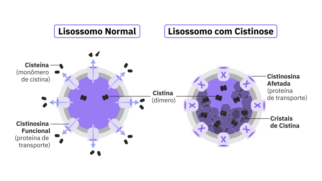 Comparação entre um lisossomo normal e um lisossomo de uma pessoa com cistinose nefropática