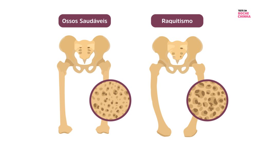 Raquitismo hipofosfatêmico (XLH) é uma doença rara que torna os ossos moles e dobráveis. Entenda a importância do diagnóstico genético no tratamento.