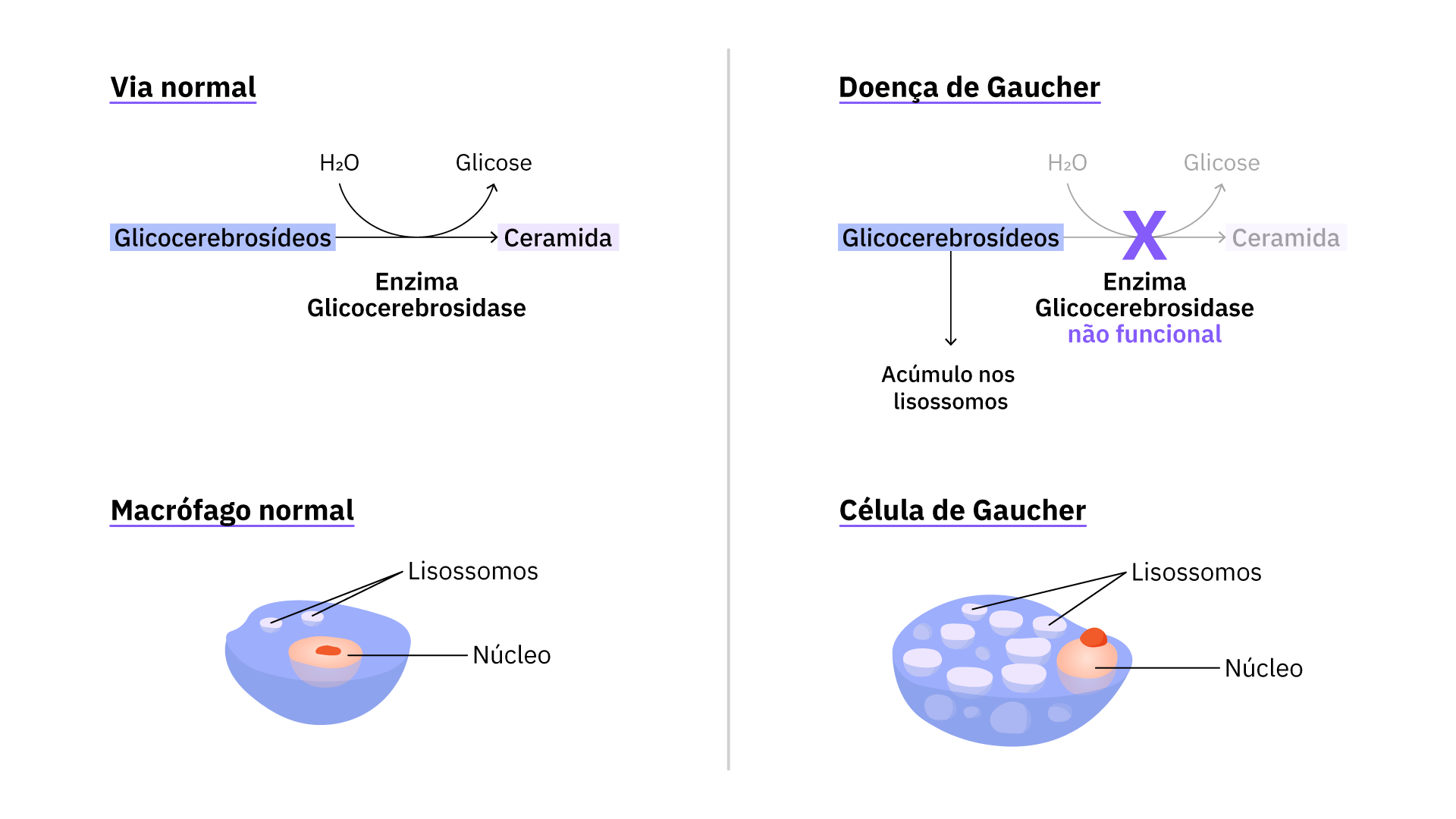 Doença de Gaucher  Concise Medical Knowledge