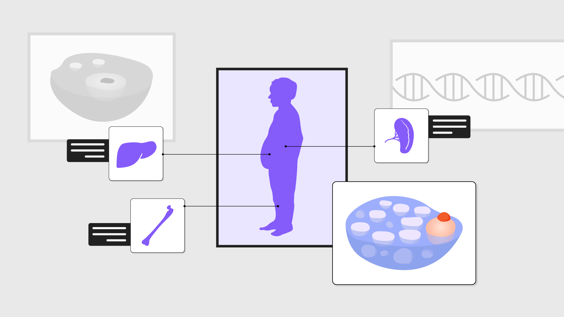 criança no centro da imagem com distensão abdominal e ícones ao lado de um osso, fígado, baço e célula de gaucher