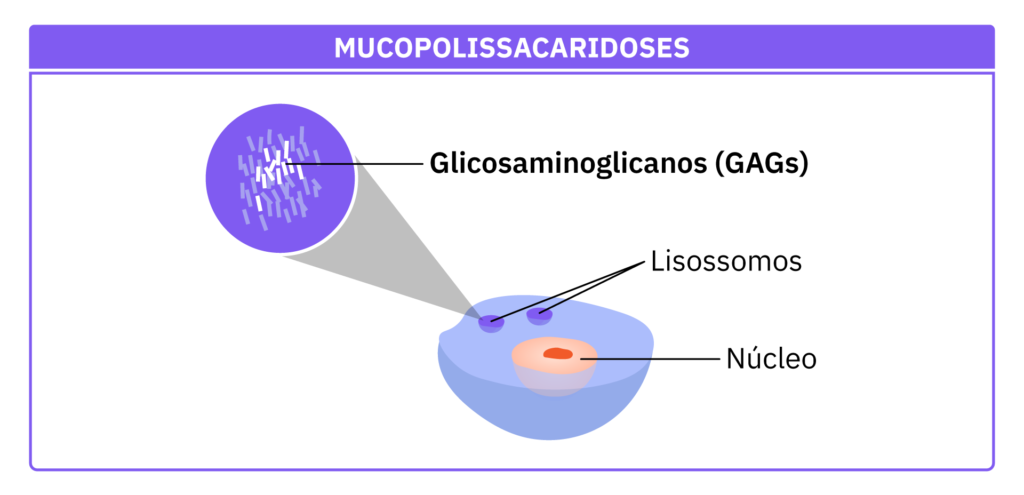 Célula afetada com o acúmulo de glicosaminoglicanos nos lisossomos.